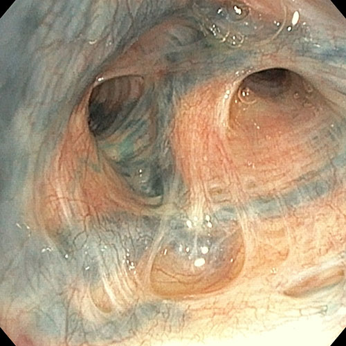 View of lungs with blue bronchoscopy technique